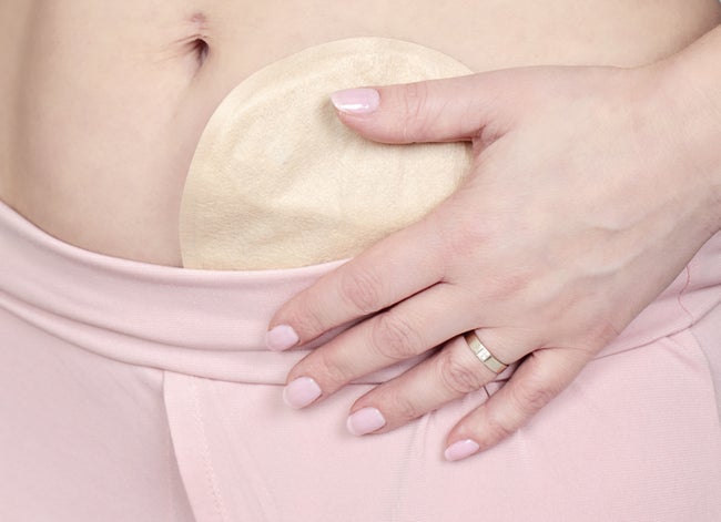 colostomy pouch attached to patient - image